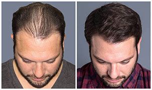 hair transplants st louis|Bosley Hair Transplant & Restoration .